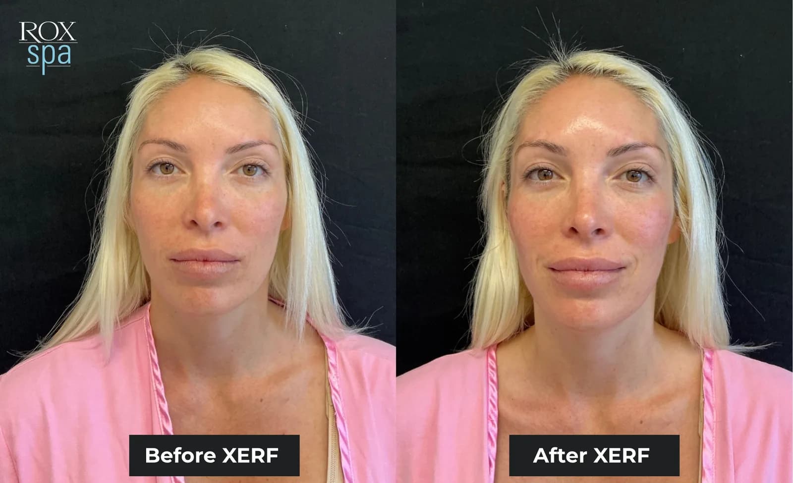 A patient photographed from the front before and after XERF treatment, shown side by side and labelled by the practice