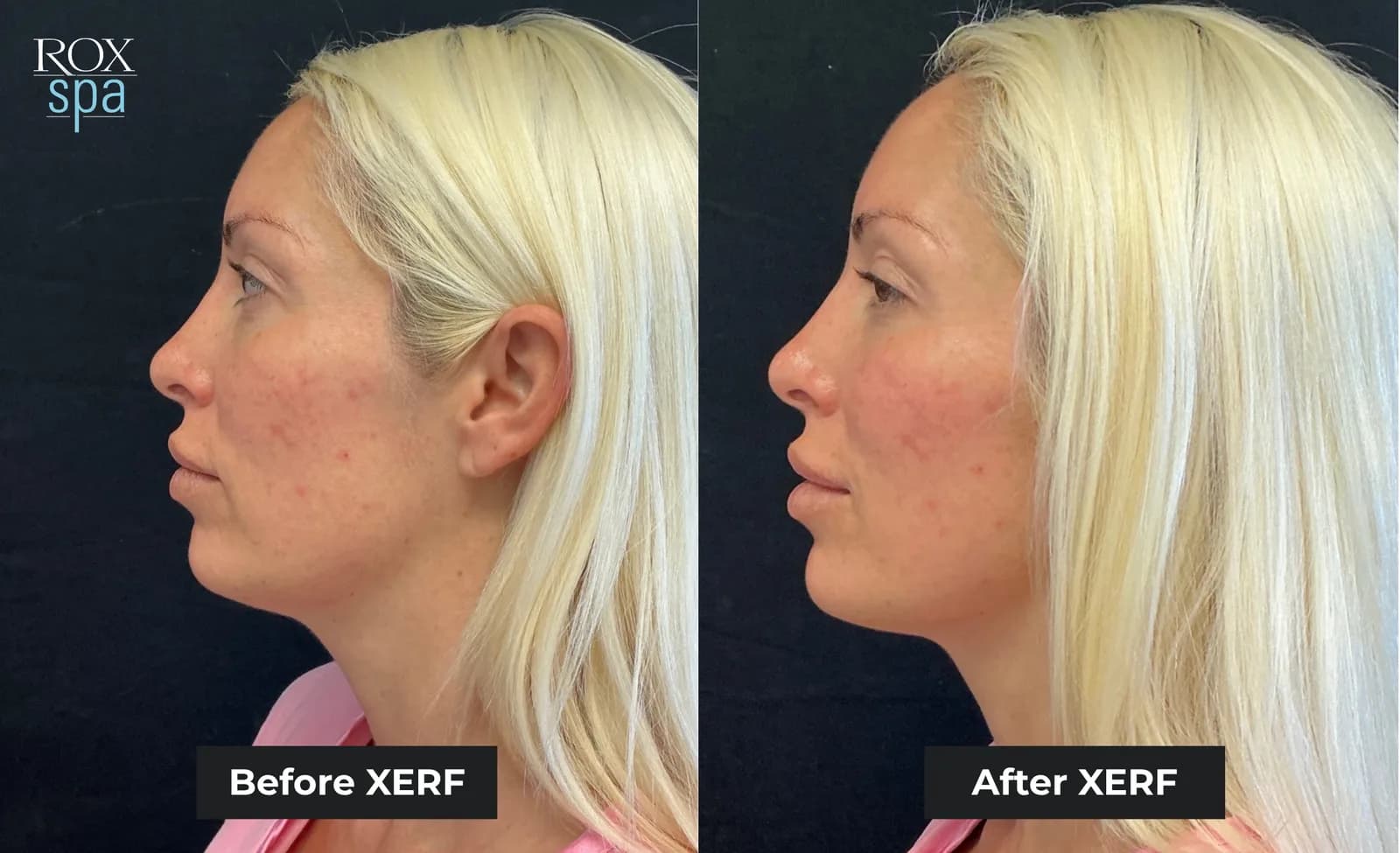 The same patient photographed in profile before and after XERF treatment, shown side by side and labelled by the practice