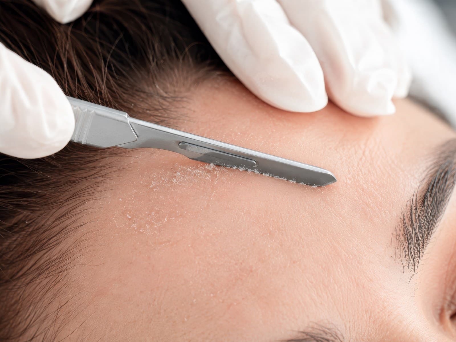 A dermaplaning blade held flat against a forehead by gloved hands, lifting fine surface debris